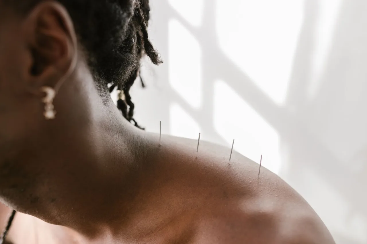 Acupuncture needles placed on a patient’s shoulder